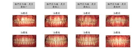 門牙大小|側門牙的變化，對美觀與笑容的影響